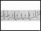  Electrocardiogram of paroxysmal supraventricular tachycardia