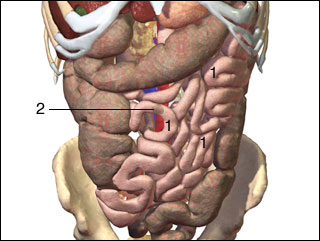 Intestinal obstruction