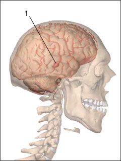 Cerebral aneurysm