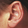 Tinnitus - causes