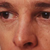 Glaucoma - Signs/symptoms
