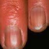 Nails - Nail diseases