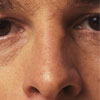 Cosmetic surgery - Nasal surgery