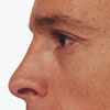 Hay fever - Signs/symptoms