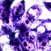 STD - Chlamydia(NSU)