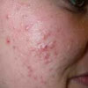 Acne - Facial (topical) treatments