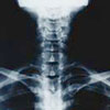Joint surgery - Spine